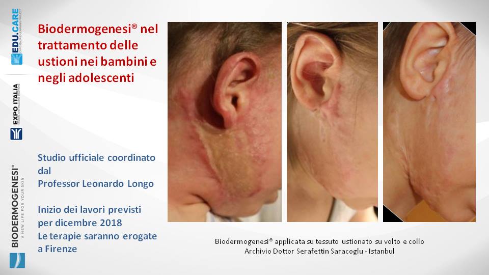 Criteri d’inclusione allo studio sulle ustioni
