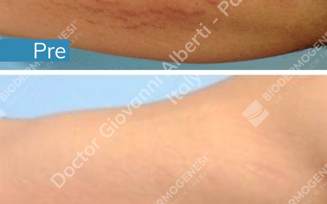 Regenerate your stretch marks with Biodermogenesi®