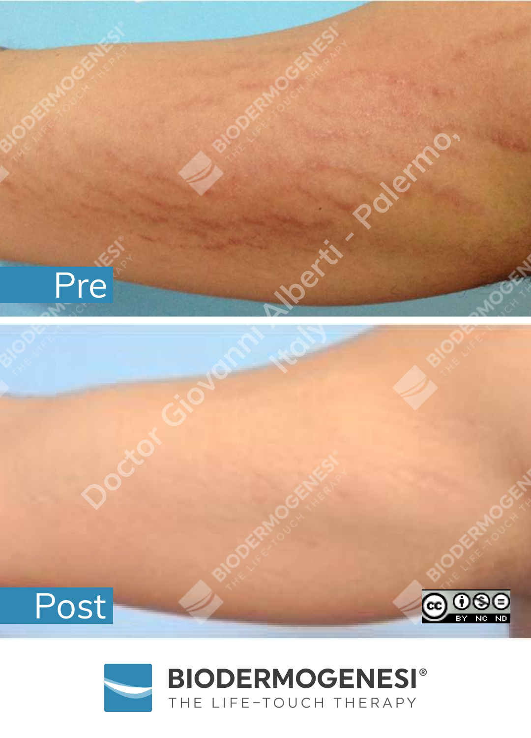 bdg-sm-008-pre e post