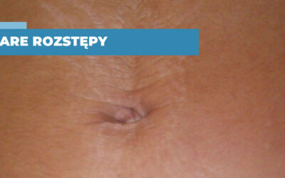 Jak leczyć stare, białe i perłowe rozstępy
