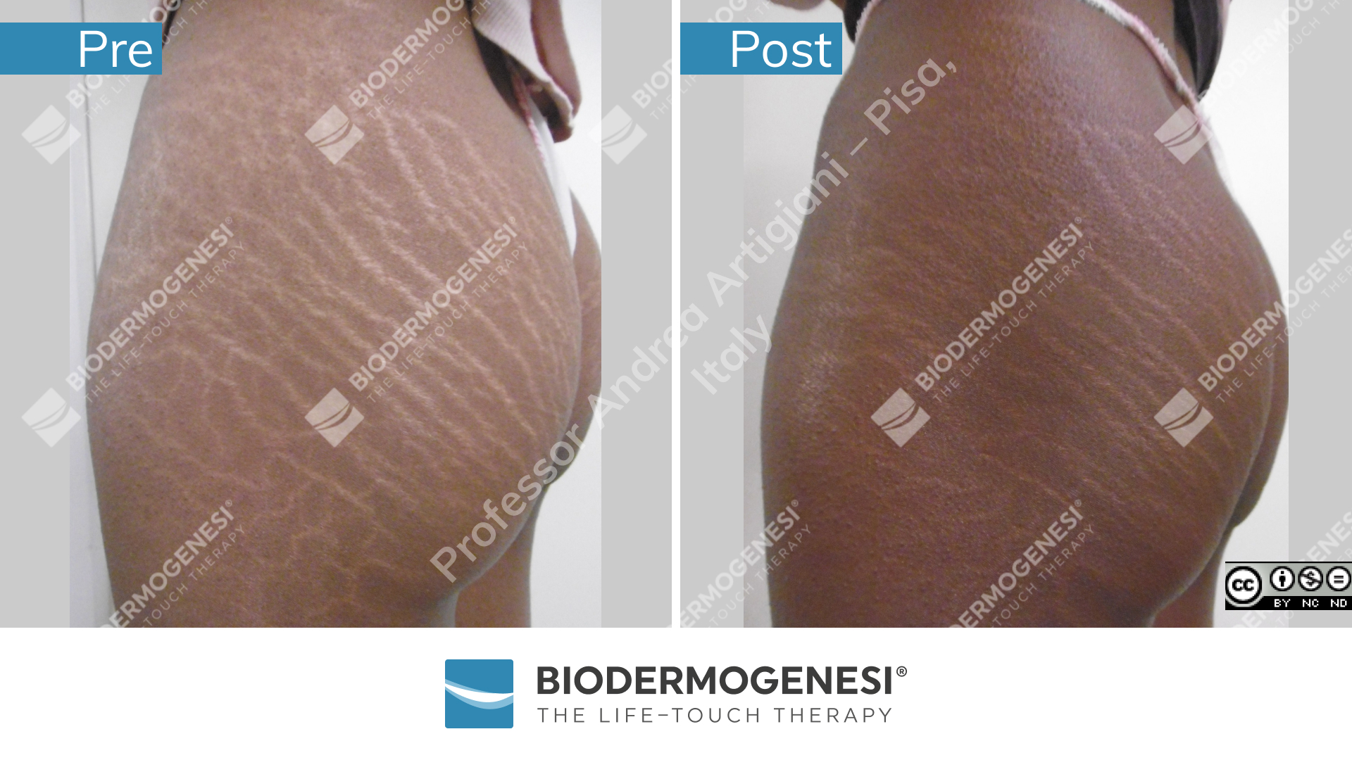 bdg-sm-033-pre e post (2)
