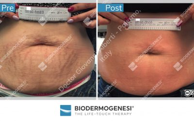 Choose Biodermogenesi®!